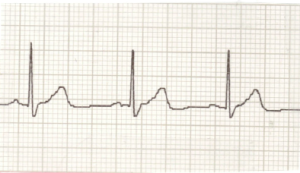 My ECG recorded on December 16, 2014 at 1 pm.