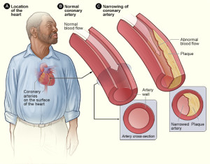 Atherosclerosis plaque.  Image attribution: Wikimedia Commons, Public Domain, N.I.H.