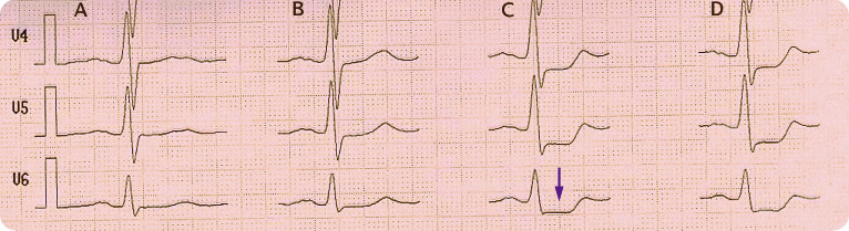 demystifying-the-cardiac-stress-test-athletic-heart-sf